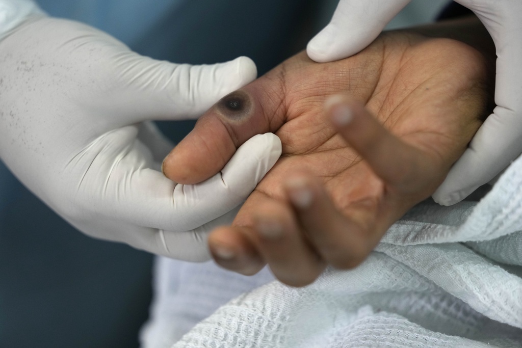 Lloji i ri i Mpox në Zvicër